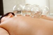 picture of cup  - Fire cupping cups on back of female patient in Acupuncture therapy - JPG 