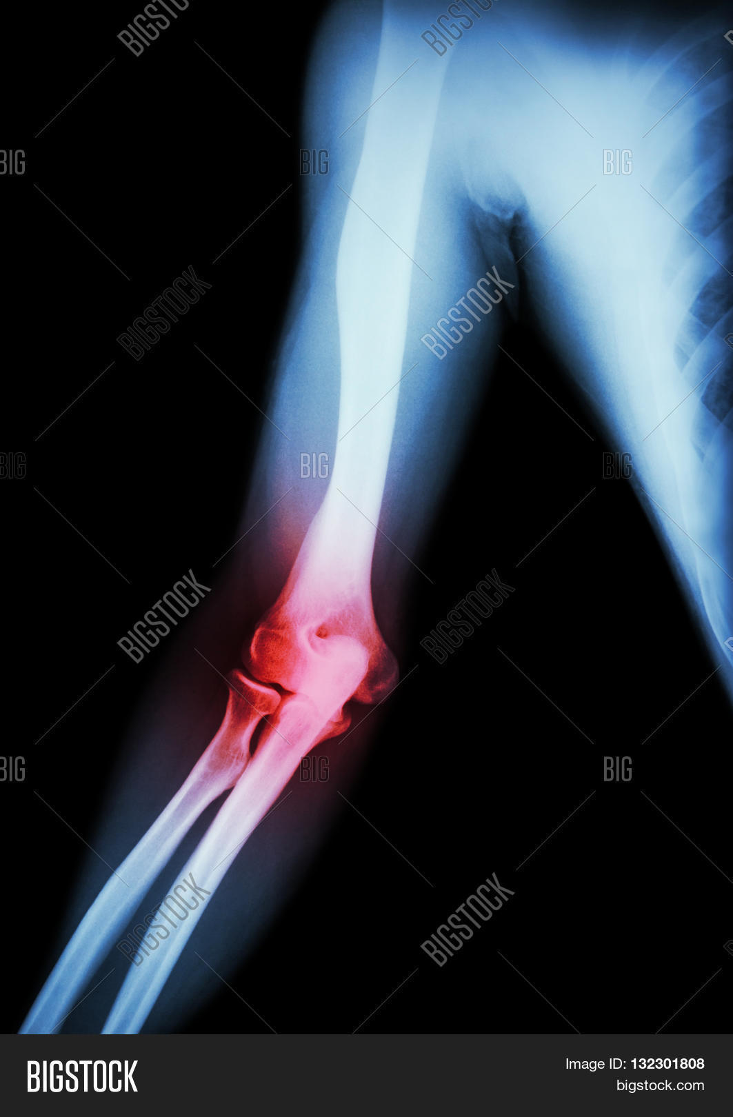 Arthritis at elbow . film xray of arm elbow forearm and inflammation