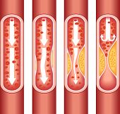 stock photo of vein  - vienna human atherosclerosis - JPG 