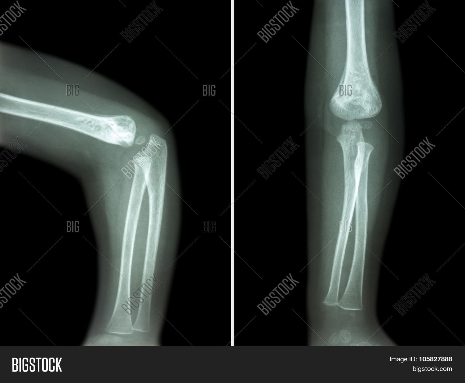 Film Xray Child 's Elbow ( Normal Image & Photo Bigstock
