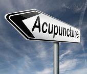 stock photo of insert  - acupuncture an alternative medicine with needles inserted on energy lines - JPG 