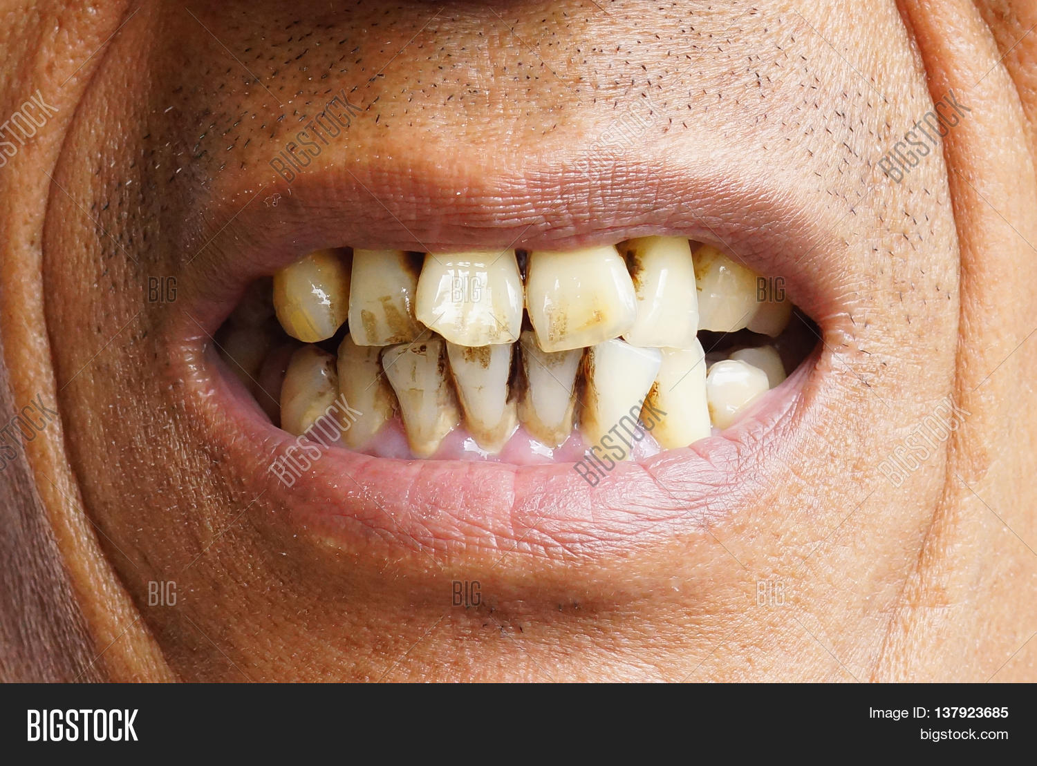 Man Yellow Teeth Due Heavy Smoking Image & Photo Bigstock