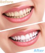picture of health  - bleaching teeth treatment  - JPG 