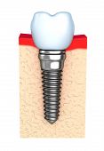 stock photo of embed  - Dental implant in jaw bone 3d render - JPG 
