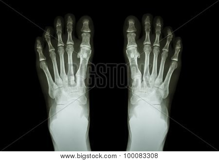 Film X-ray Both Foot ( Front View )