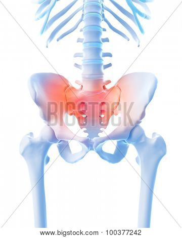 medical 3d illustration of a painful sacrum