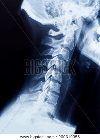 X-Ray photo of neck and skull .