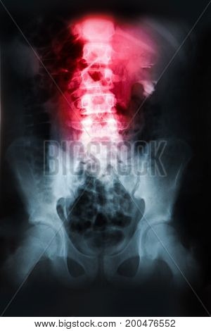 X-ray of the pelvis and spinal column. The lumbar spine is highlighted by red colour.