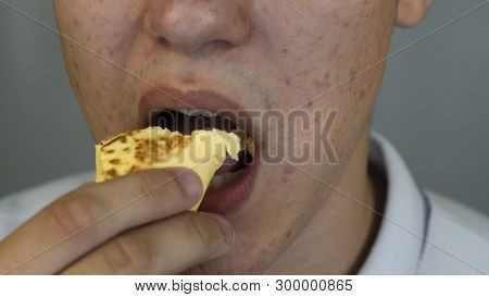 Man With Pimples And Acne On The Face Is Eating Unhealthy Food, Macro