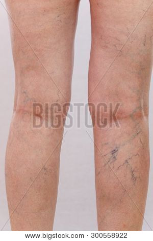 Elderly woman in white panties shows cellulite and varicose veins on a light isolated background. Co