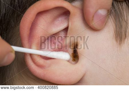 Mothers Hand Cleaning Baby Ear With Cotton Swab. Closeup Of Mothers Hands Are Cleaning Childs Ear Wi