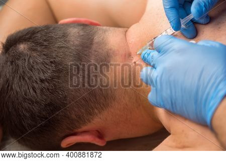 Surgeon In Gloves Gives Injection Of Local Anesthesia To Patient Before Laser Removing Of Moles Or P