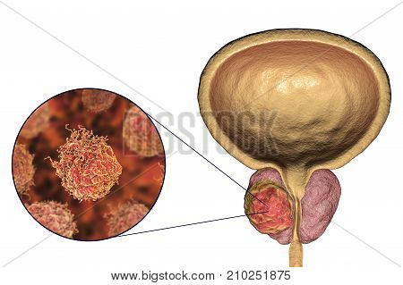 Prostate cancer, 3D illustration showing tumor inside prostate gland and closeup view of cancer cells