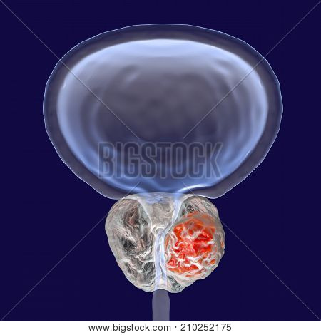 Prostate cancer, 3D illustration showing presence of tumor inside prostate gland which compresses urethra