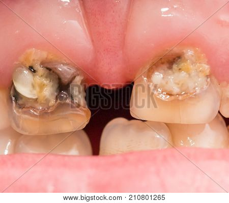 rotten teeth. macro Photos in the studio