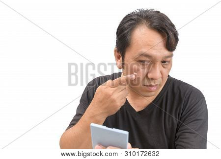 Middle-aged Asian Man Applying Cream Onto Face With Melasma Or Blemish And Brown Spots. Skincare Or 