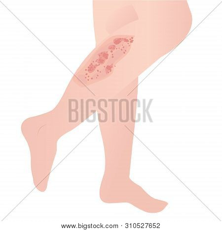 Psoriasis Skin Disease On A White Background Vector Illustration