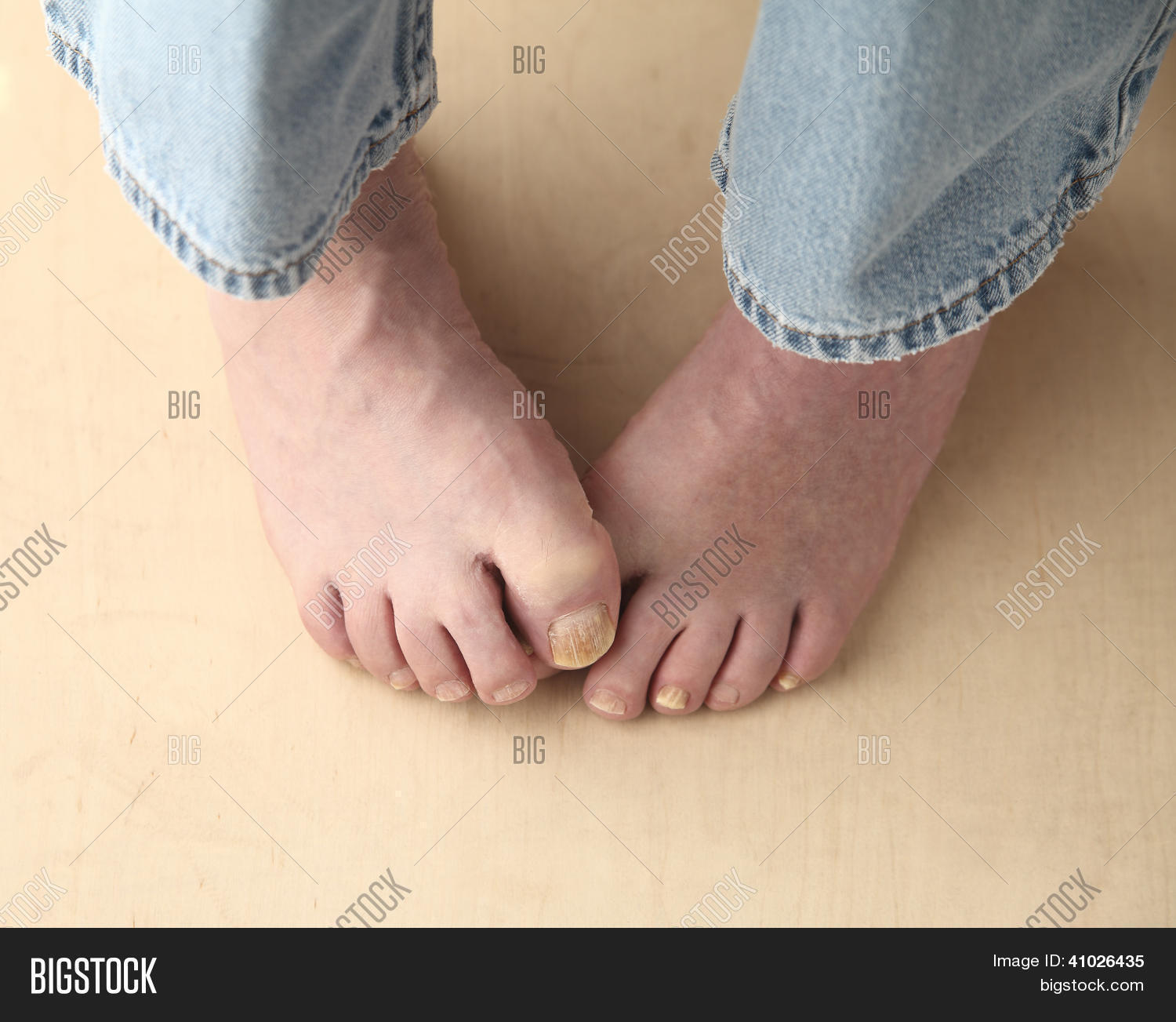 подошва ноги. проблемы со стопами. стричь ногти на ногах картинка. косточка мизинец вальгус операция. плоскостопие у взрослых.