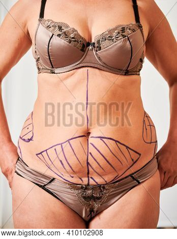 Close Up Of Patient Belly With Blue Marks For Aesthetic Surgery. Fat Woman In Underwear Demonstratin