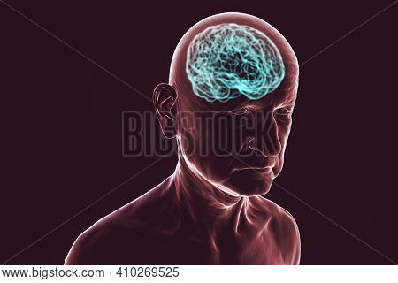 Dementia, Conceptual 3d Illustration Showing An Elderly Person With Progressive Impairments Of Brain