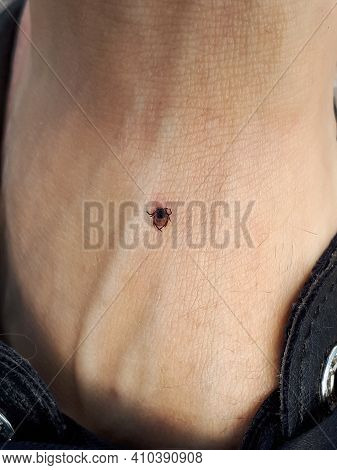 Tick With Its Head Sticking In Human Skin On A Leg, Sucked Deep Under The Skin
Close Up Of Tick, Red