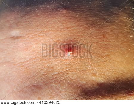 Macro Shot Of A Red Irritated Pimple With White Pus Squeezed Out On A Forehead On Tanned Mature Skin