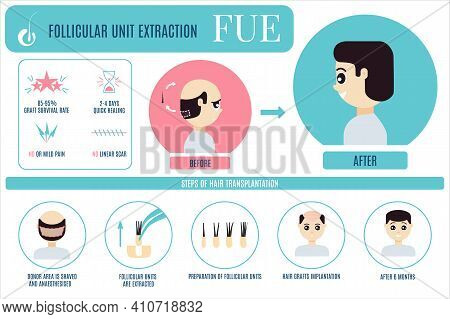 Fue Hair Treatment For Men Infographic Poster