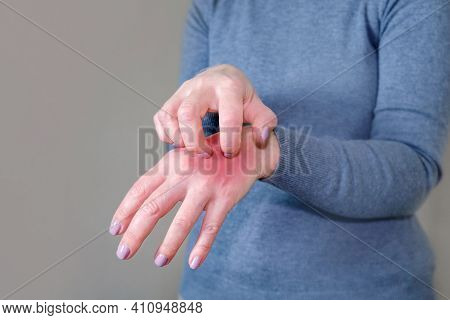 The Girl In The Gray Jumper Scratches Her Hand. Scabies. Inflammation Of The Skin. Disease Of The Sk