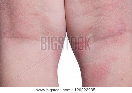 Eczema On The Kid's Legs