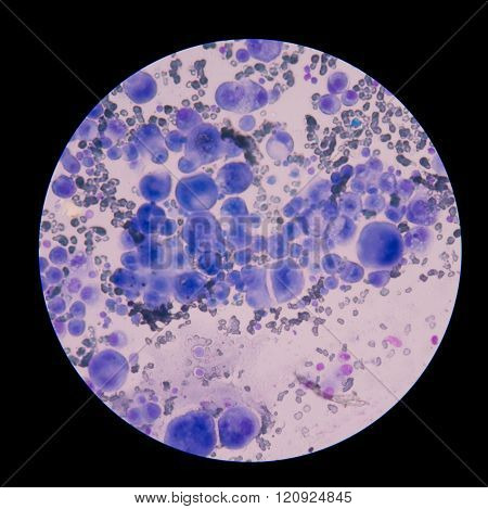 malignant cells with multiple nuclei and prominent nucleoli.Mesothelial cells