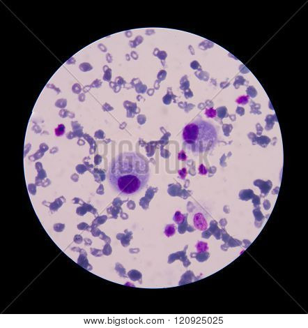 malignant cells with multiple nuclei and prominent nucleoli.Mesothelial cells