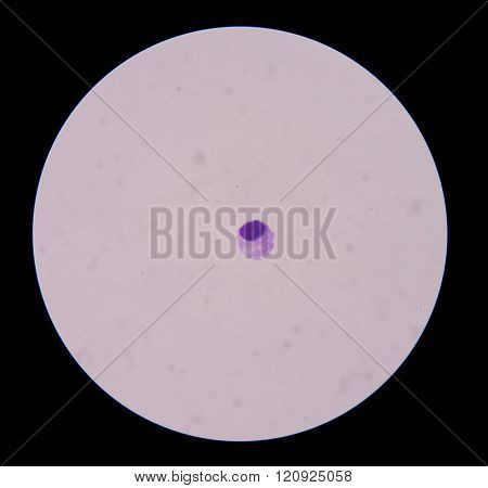malignant cells with multiple nuclei and prominent nucleoli.Mesothelial cells