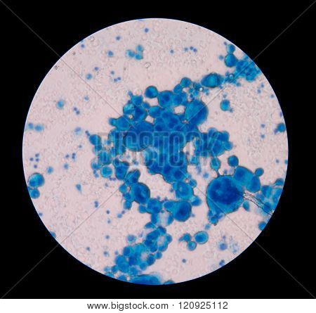 malignant cells with multiple nuclei and prominent nucleoli.Mesothelial cells