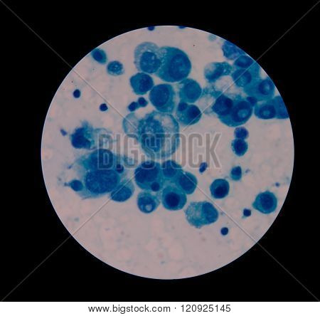 malignant cells with multiple nuclei and prominent nucleoli.Mesothelial cells
