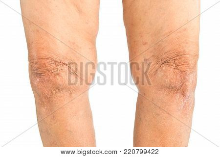 Elderly woman Varus deformity or bow legs