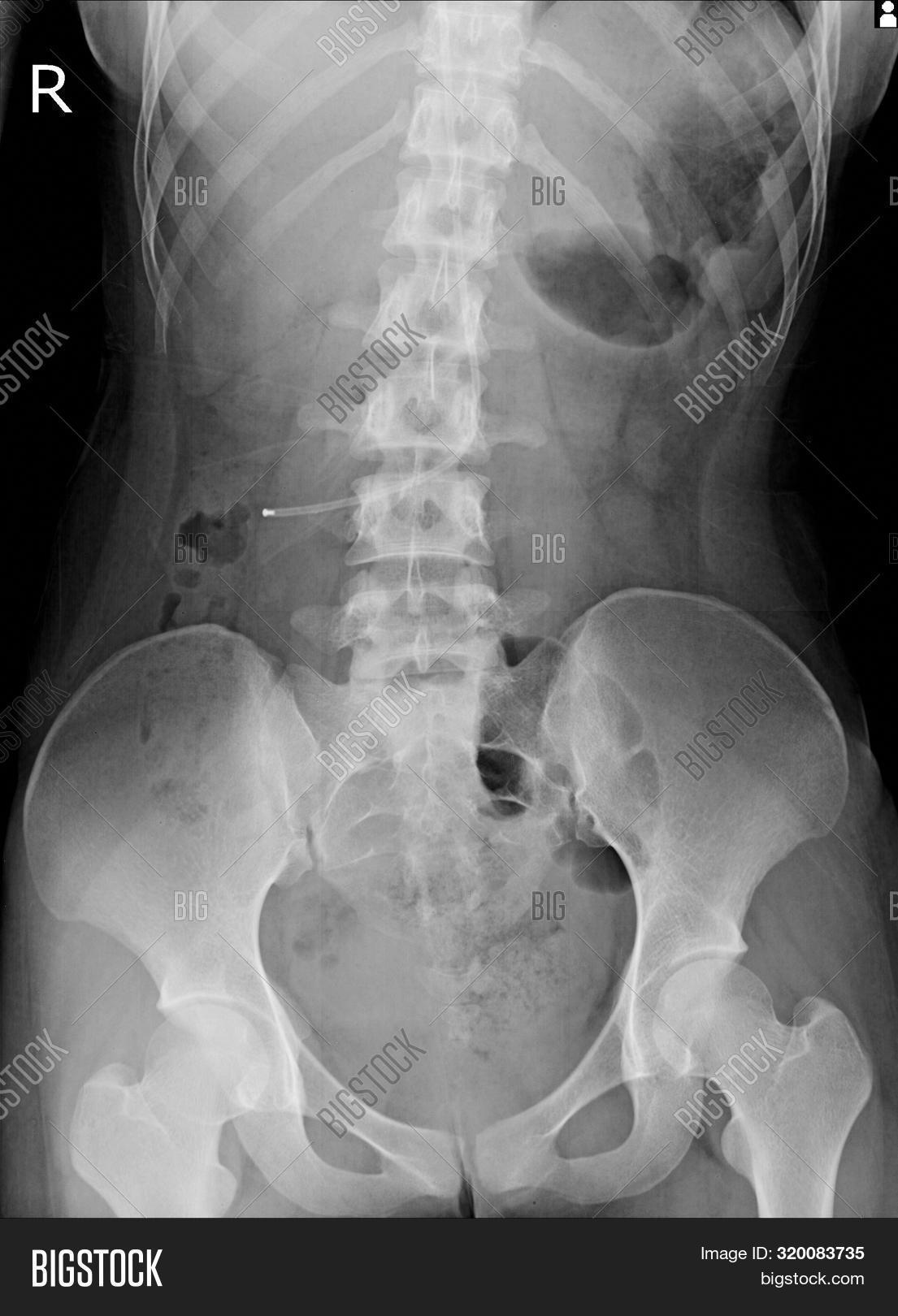 Pacemaker Xray Image Image & Photo (Free Trial) Bigstock