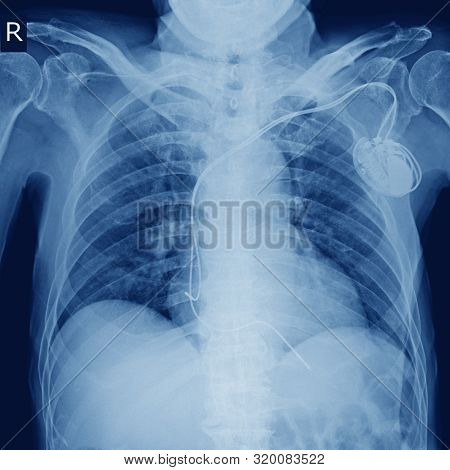 X-ray Image Of Permanent Pacemaker Implant In Body Chest.