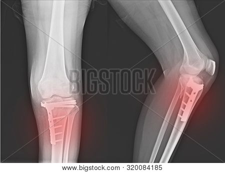 X-ray Knee Joint Fracture Proximal Tibia And Post Fix Fracture Proximal Tibia With Plate And Screws.
