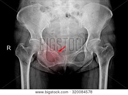 Both Hip X-ray Fracture Right Superior Pubic Ramus.normal Both Hips.