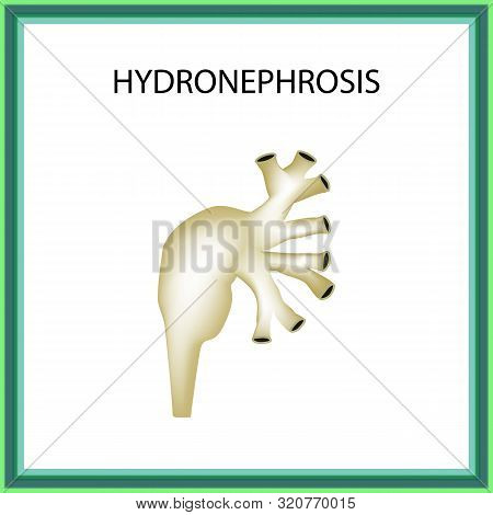 Hydronephrosis. Pelvis. Kidney. Infographics. Illustration On Isolated Background