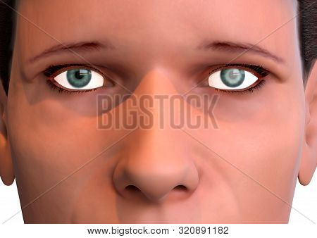 Closeup Of Human Eye With Advanced Glaucoma Detected During Ophthalmic Examination