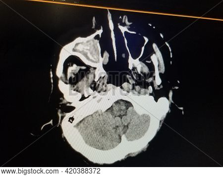 Coronal Ct Scan Of The Sinuses - Right Maxillary Sinusitis
