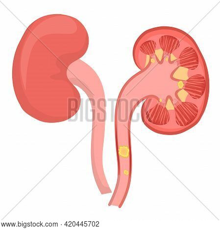 Vector Illustration Of Kidney Stones Isolated On A White Background.the Concept Of Kidney Disease