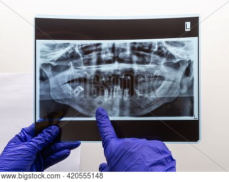 The Dentist Hand Show Problem Area In The Lower Jaw Bone On A Panoramic X-ray Of An Old Person With 