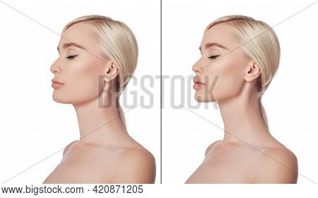 Before And After Plastic Chin Surgery Woman. Cosmetic Chin Correction, Plastic Surgery, Reduction Su