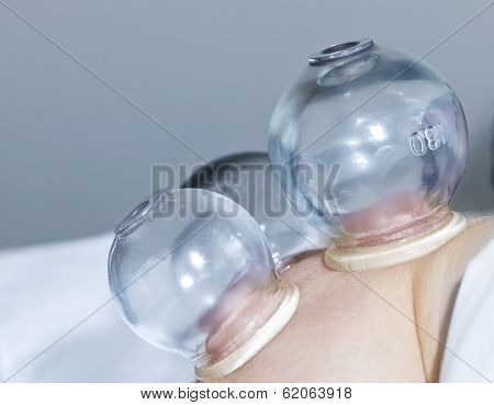 Applying cupping therapy in traditional chinese medicine on man's shoulder