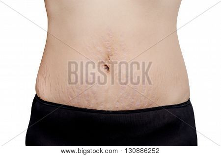Asian woman showing stretch marks on her tummy skin