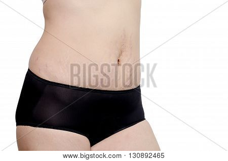 Asian woman showing her stretch marks over white