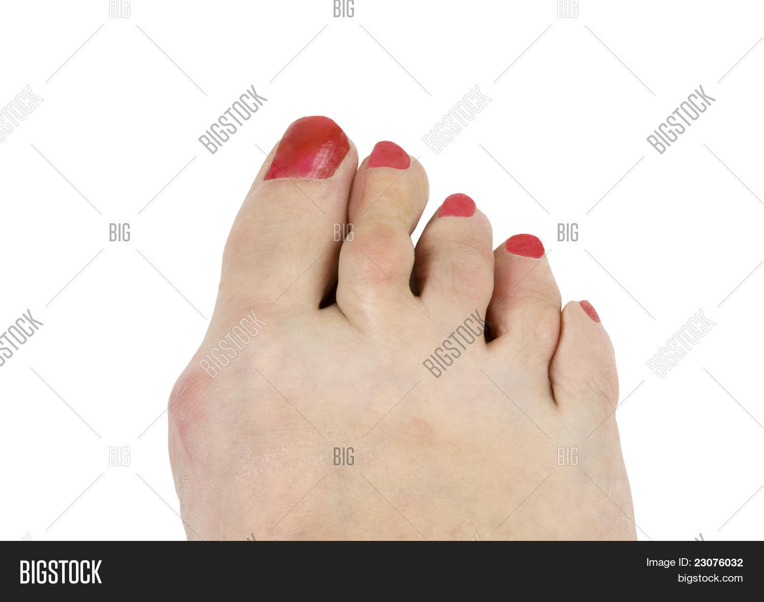 Hammer Toe Bunion Image & Photo (Free Trial) Bigstock