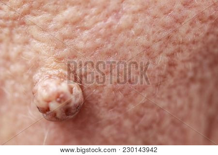 Details Of Senior Woman Face. Elderly Pensioner Female, Dermal Fibroma Close Up.